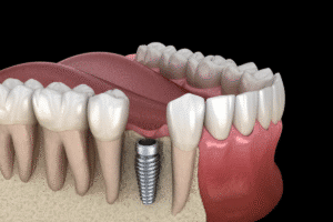 What side effects are associated with titanium screws in orthopedic procedures?