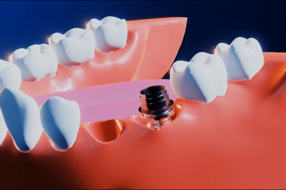 How can side effects of titanium implants be minimized?