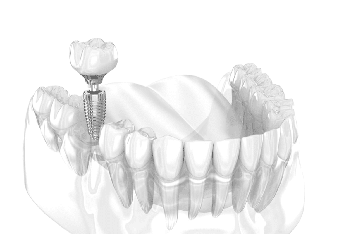 What are the possible side effects associated with titanium implants?