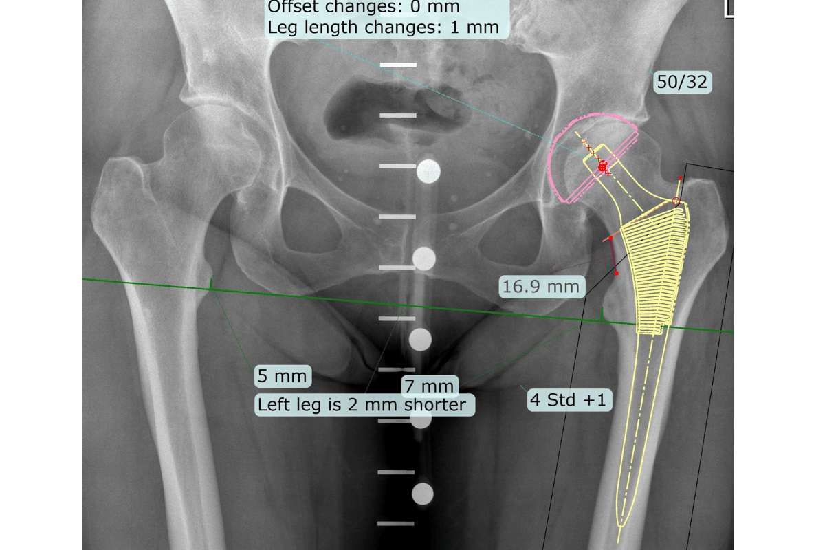how much does a titanium hip replacement weigh