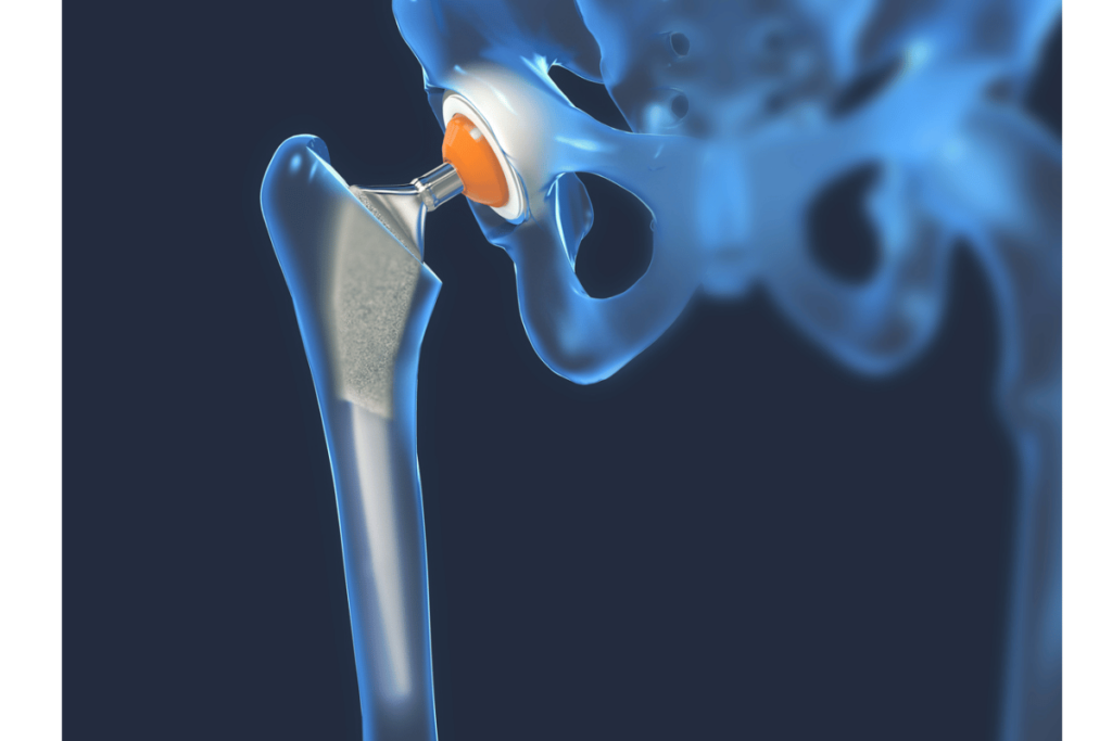how much does a titanium hip replacement weigh