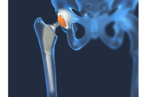 how much does a titanium hip replacement weigh