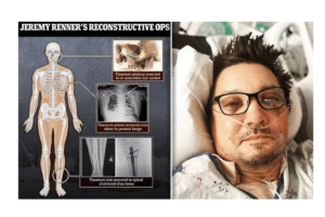 long-term effects of titanium in body