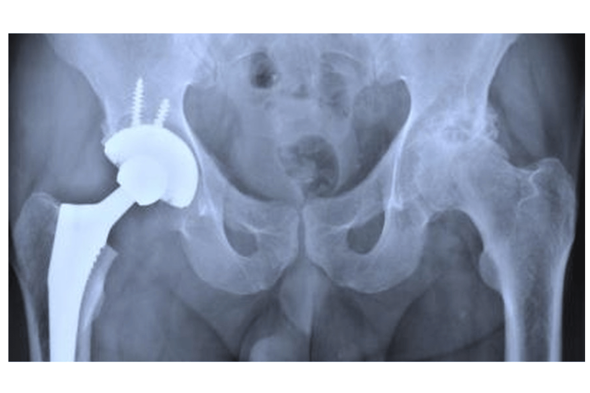 titanium piercing in mri 