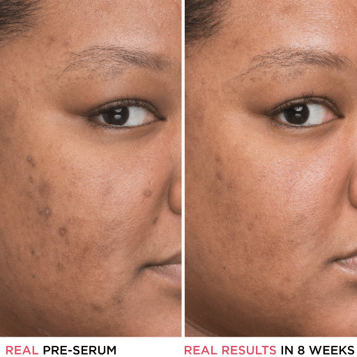 What is Niacinamide and Why is it Essential for Skin Care?